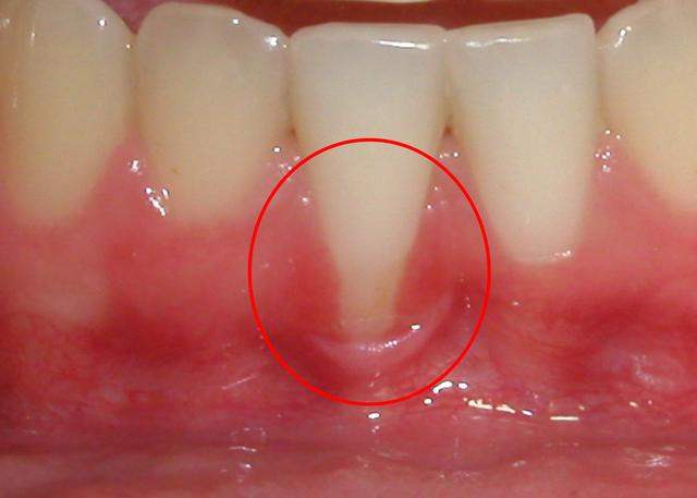 慢性牙周炎有哪些症状呢