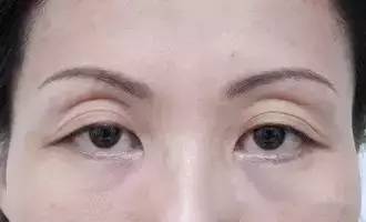 三眼皮可能不仅是眼睑皮肤松弛,还有可能是眼窝凹陷