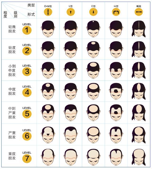 张东升的"秃顶"是用脑过度造成的,还是属于脂溢性脱发?