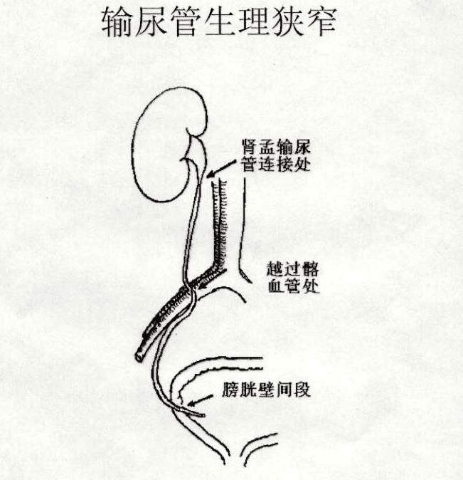 有哪些方法可以检查输尿管
