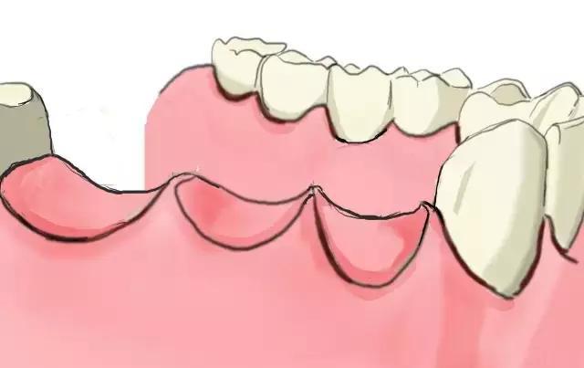 几张图告诉你传统镶牙和种牙的区别,缺牙的赶紧看!