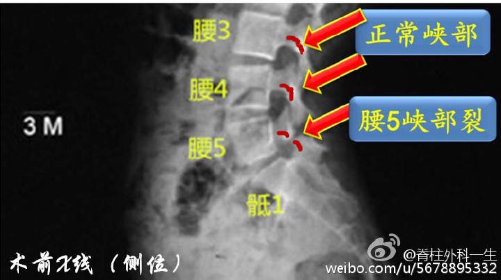 图2.  术前x线检查显示腰椎峡部裂,红色箭头.