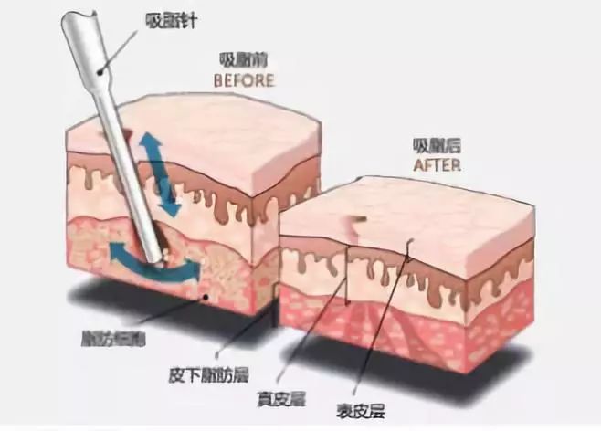 吸脂针管来回往复运动,侧孔锋利的侧壁将脂肪颗粒切割下来,随负压被