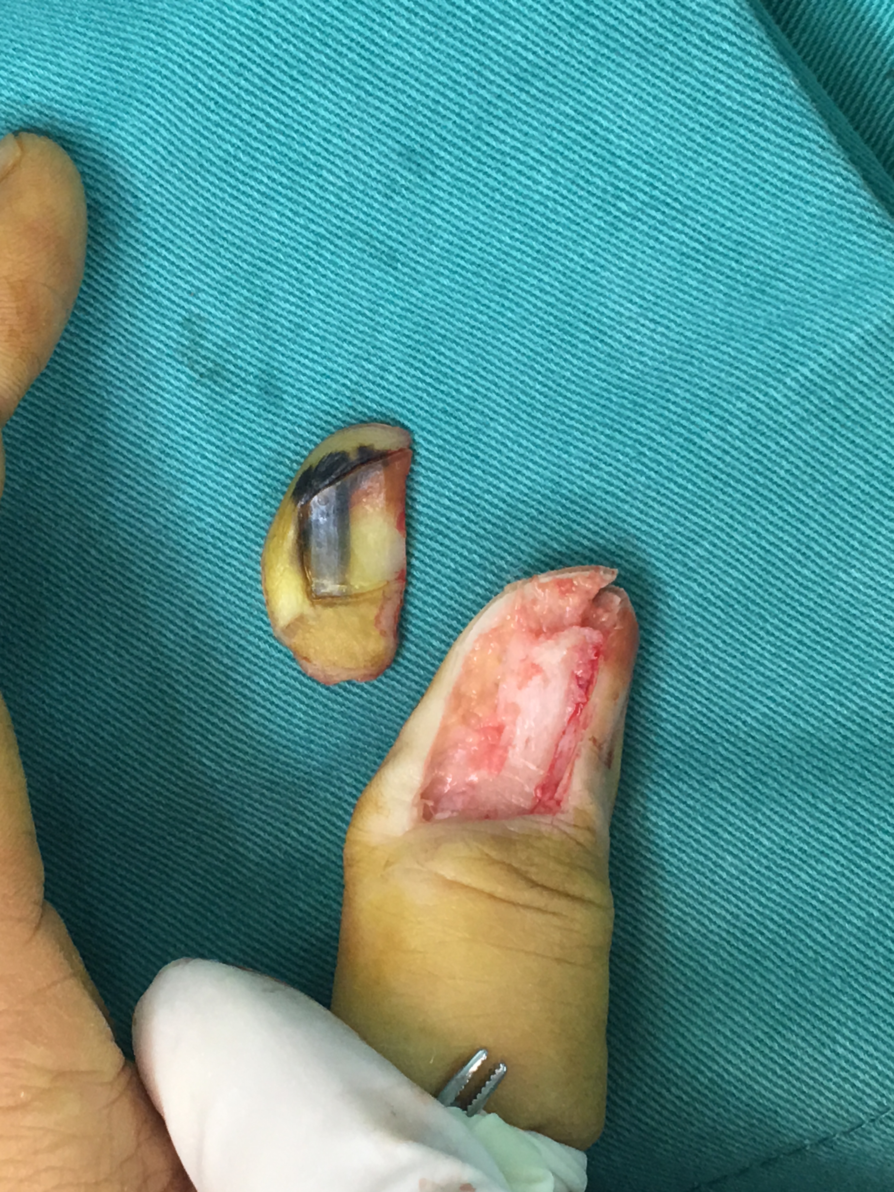 1周后病理结果提示为:拇指恶性黑色素瘤!