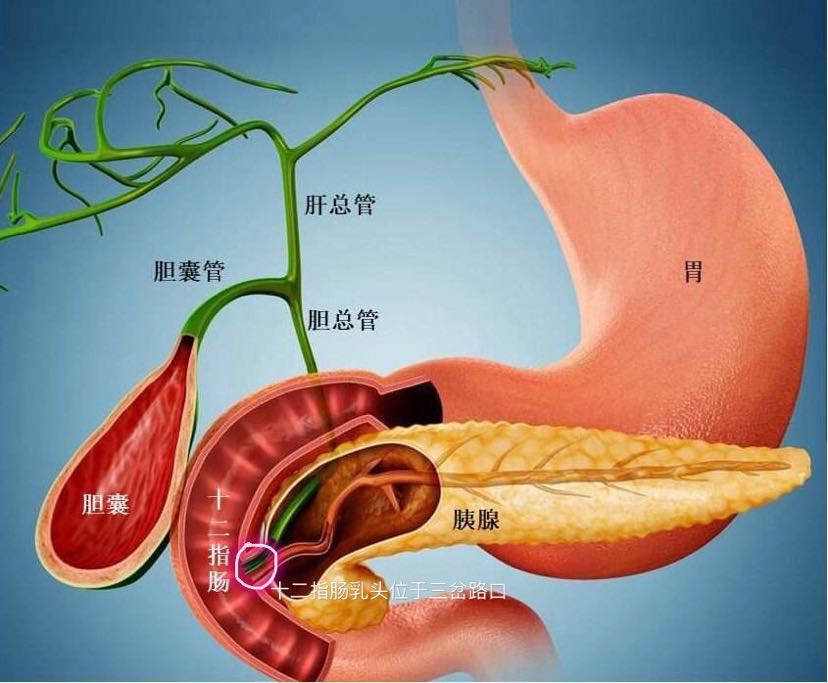 而胆管结石通常是由胆囊内掉落入胆管引起,一旦引起胰腺炎,常常会