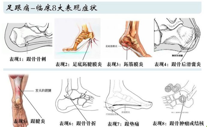 足跟痛非小病