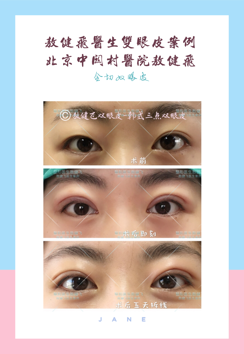 "金鱼眼"是什么?可以做双眼皮手术吗(附案例)