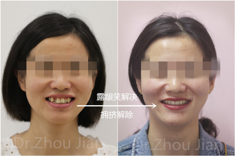 是不是二十岁的你还在为拔牙瘦脸流眼泪?