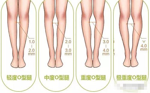 请先站直且脚后跟并拢,a两腿的大腿间有着大空隙,膝盖合不起来