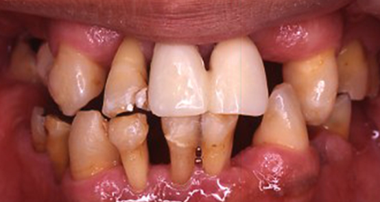 牙周炎的怎么预防和治疗