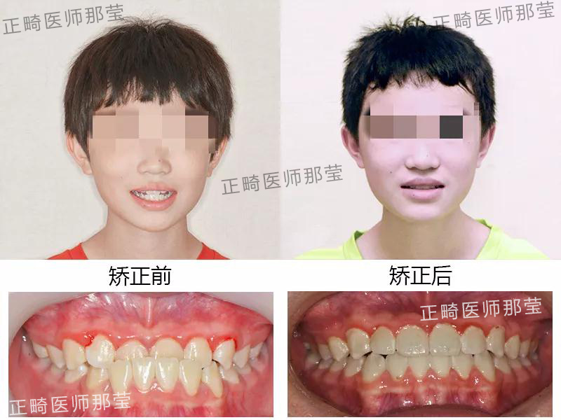 牙齿矫正前后变化究竟有多惊人?