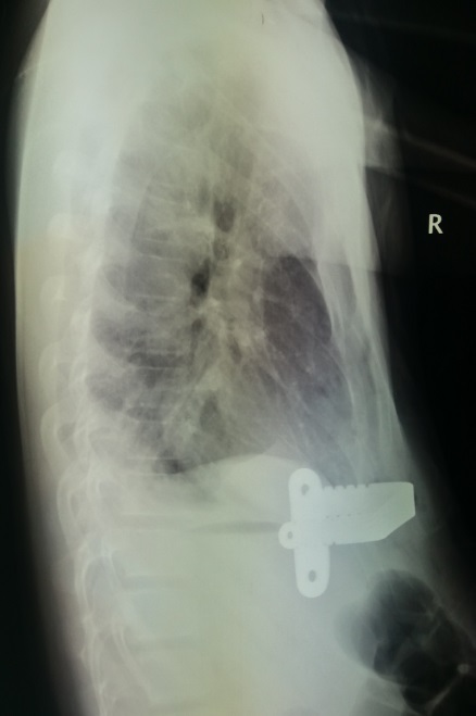 一例复杂漏斗胸二次手术成功