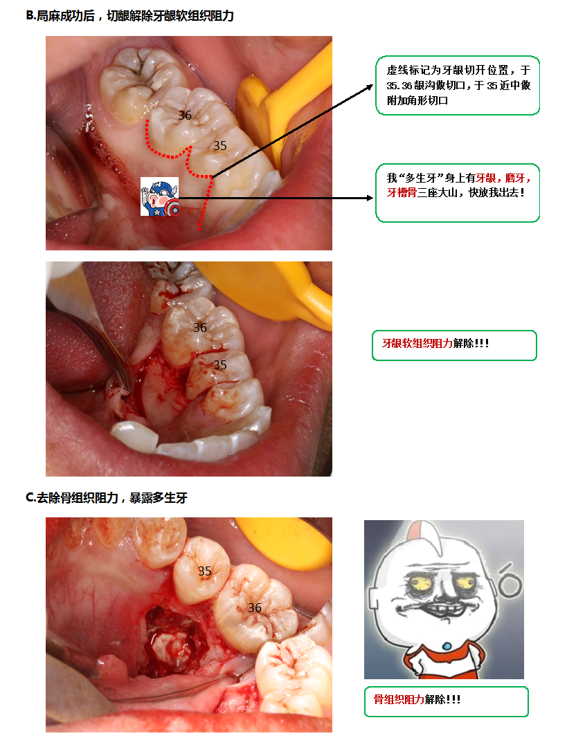 天价拔牙,阻生牙"身价"为何这么高?