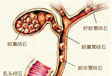 胆囊结石不处理有什么危害