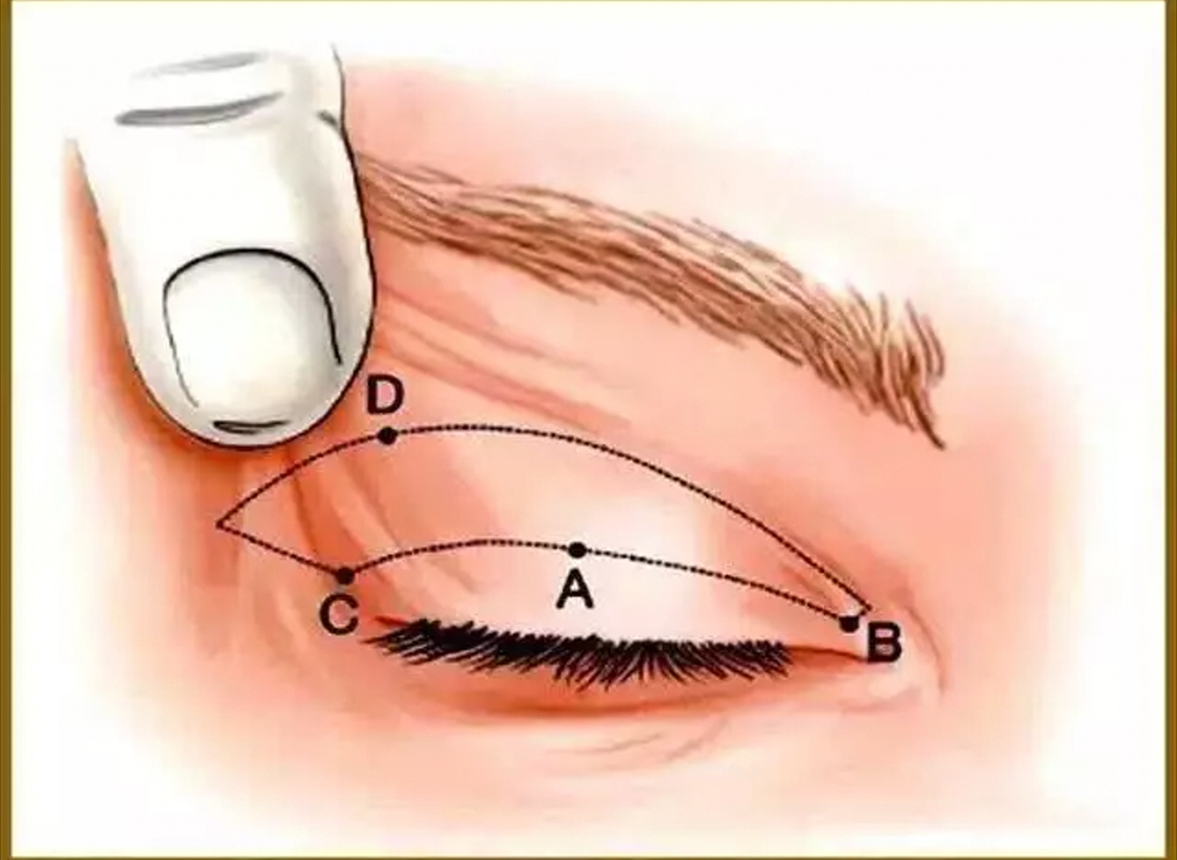 上睑皮肤松弛下垂了怎么办?