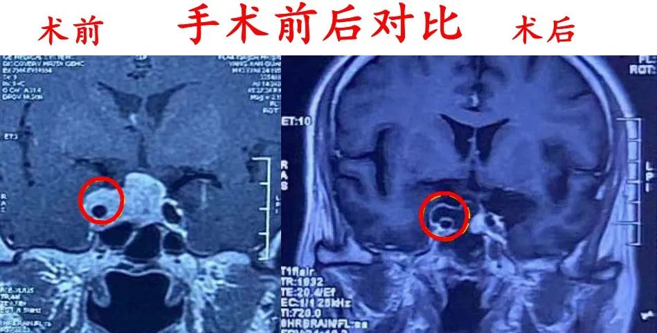 性垂体瘤侵袭性垂体瘤的主要危害是向周围侵犯海绵窦,向下突破鞍底