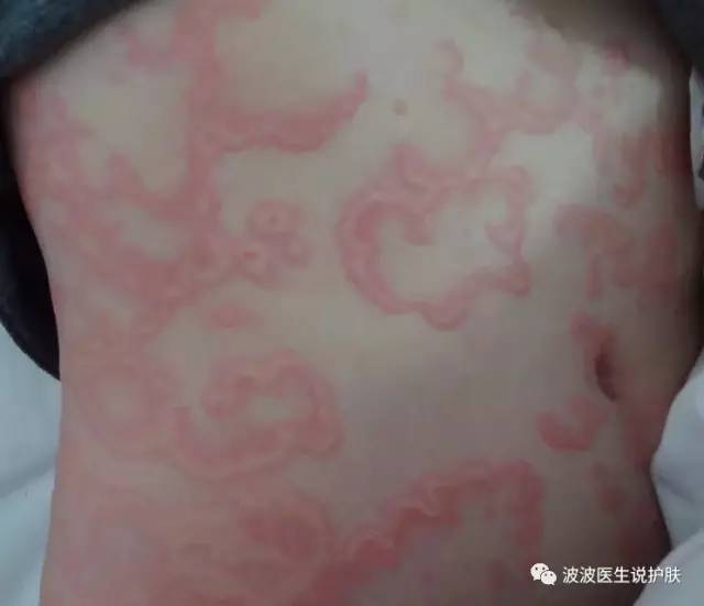 压力过大的人;  风湿病患者; 疾病起因  荨麻疹的病因错综复杂,较