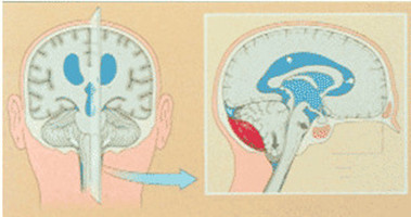 脑瘤患者需要警惕的另一种凶险脑疝