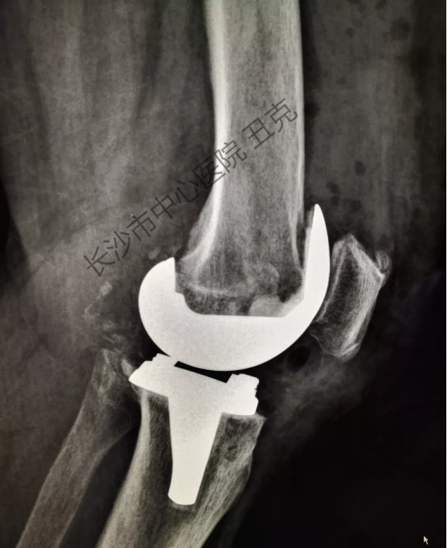 双膝关节表面置换术后x线