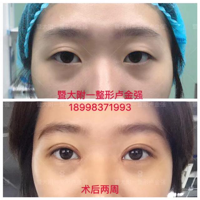 其实这个是假性双眼皮,皮肤有点松和多,又没折进去,所以向下折叠,压在
