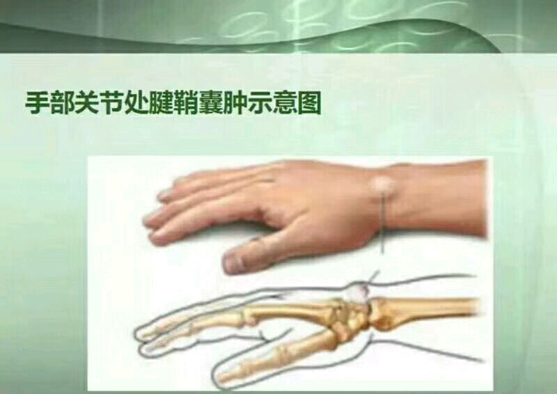 腱鞘炎发生在拇指,中指或无名指根部时,称为屈指肌腱狭窄性腱鞘炎
