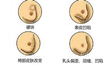 乳腺癌真正的诱因!