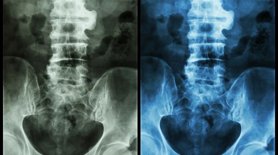 治疗,病情进展很快,可逐渐发展为 因此,强直性脊柱炎患者的日常护理