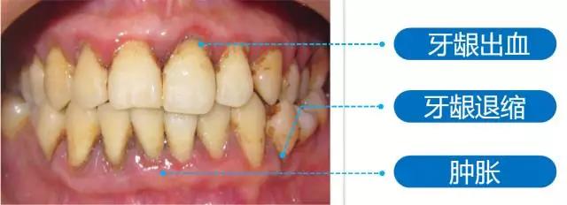 牙龈易出血不是上火是牙周病
