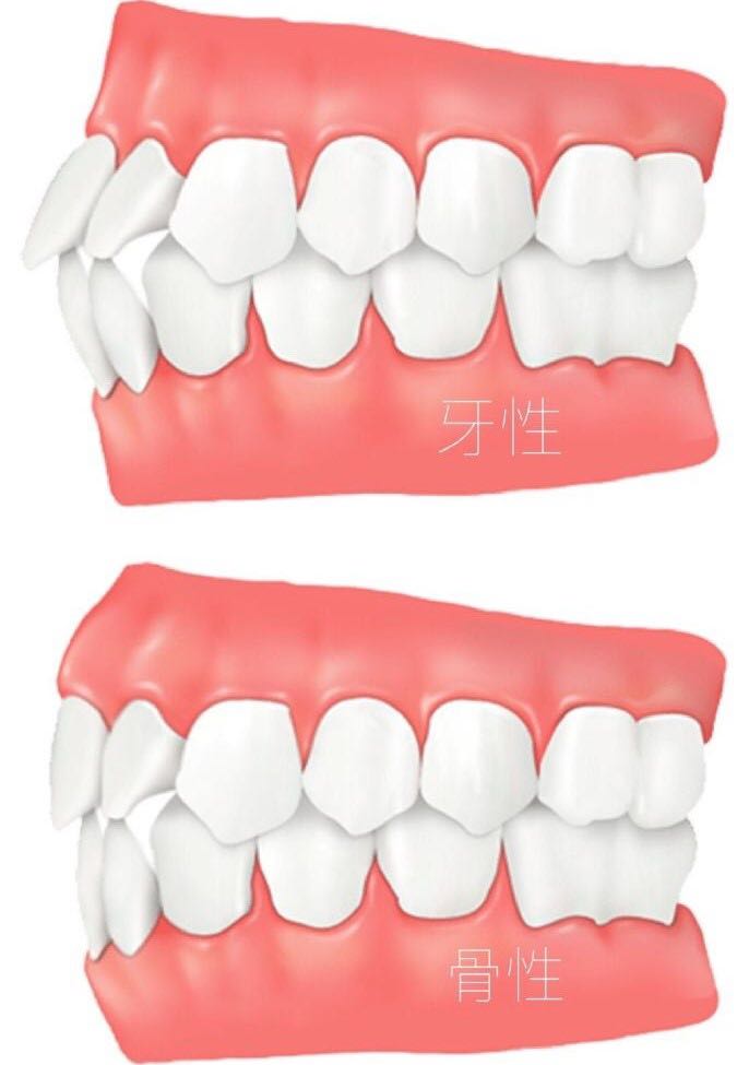 如何区别骨性嘴突和牙性嘴突?