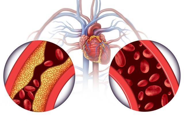 心肌缺血分5种,不同心肌缺血治疗方法不同!心血管专家说清楚