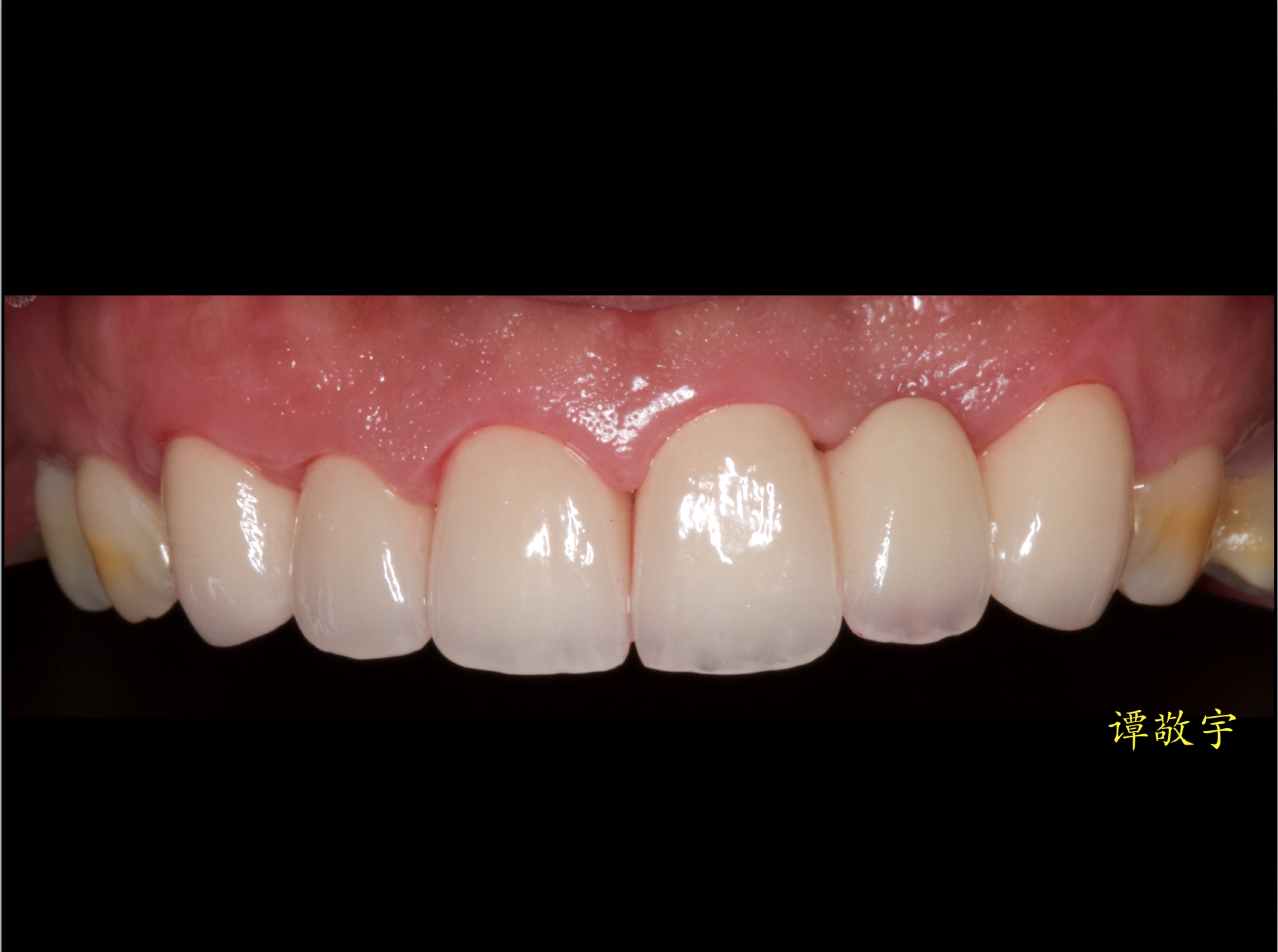 牙龈高度不一致,牙齿缺失,畸形过小牙,联合修复病例分享
