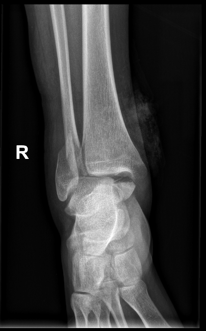 踝关节骨折1例