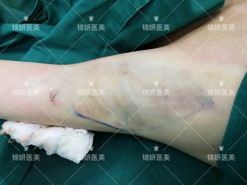 step5加压包扎