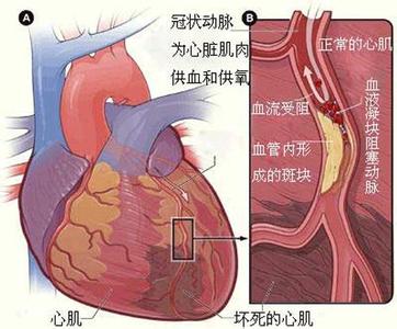 急性心肌梗死死亡率极高,在传统医学中被称之为"真心痛,关于真心痛有