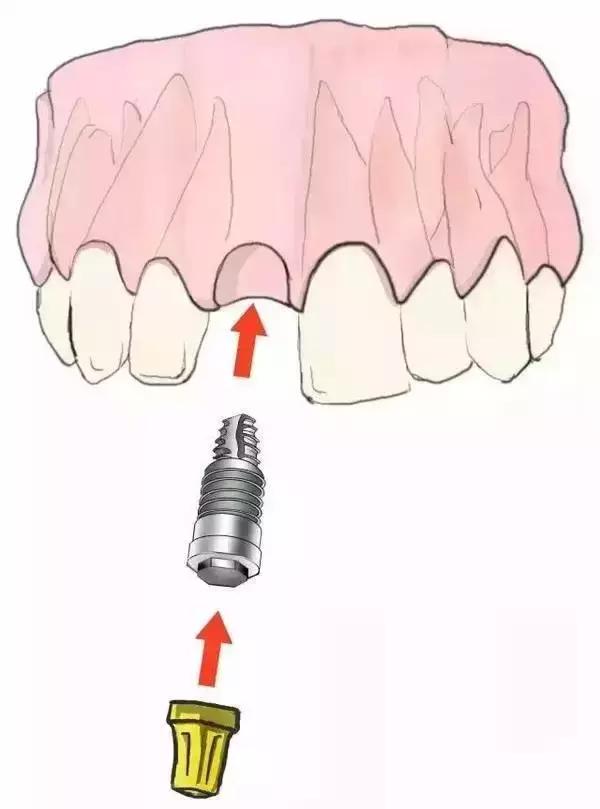 种植牙 植入种植钉(种植牙就是缺哪颗种哪颗,不会伤及健康的邻牙.