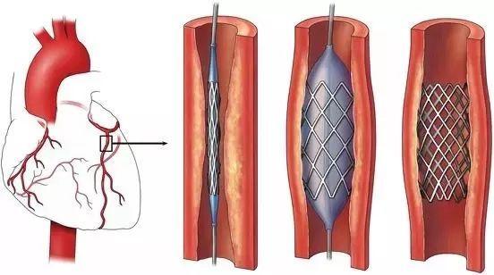 心脏支架多长时间能上班医生提醒支架后一定要知道的5个问题