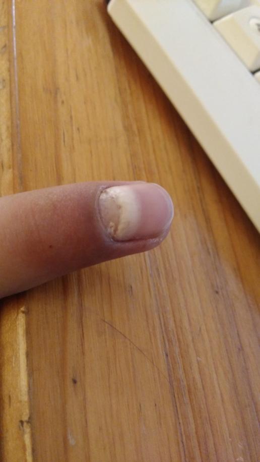 15-11-15 手指甲发白有多种可能的原因,像贫血,缺钙等都可能导致这种
