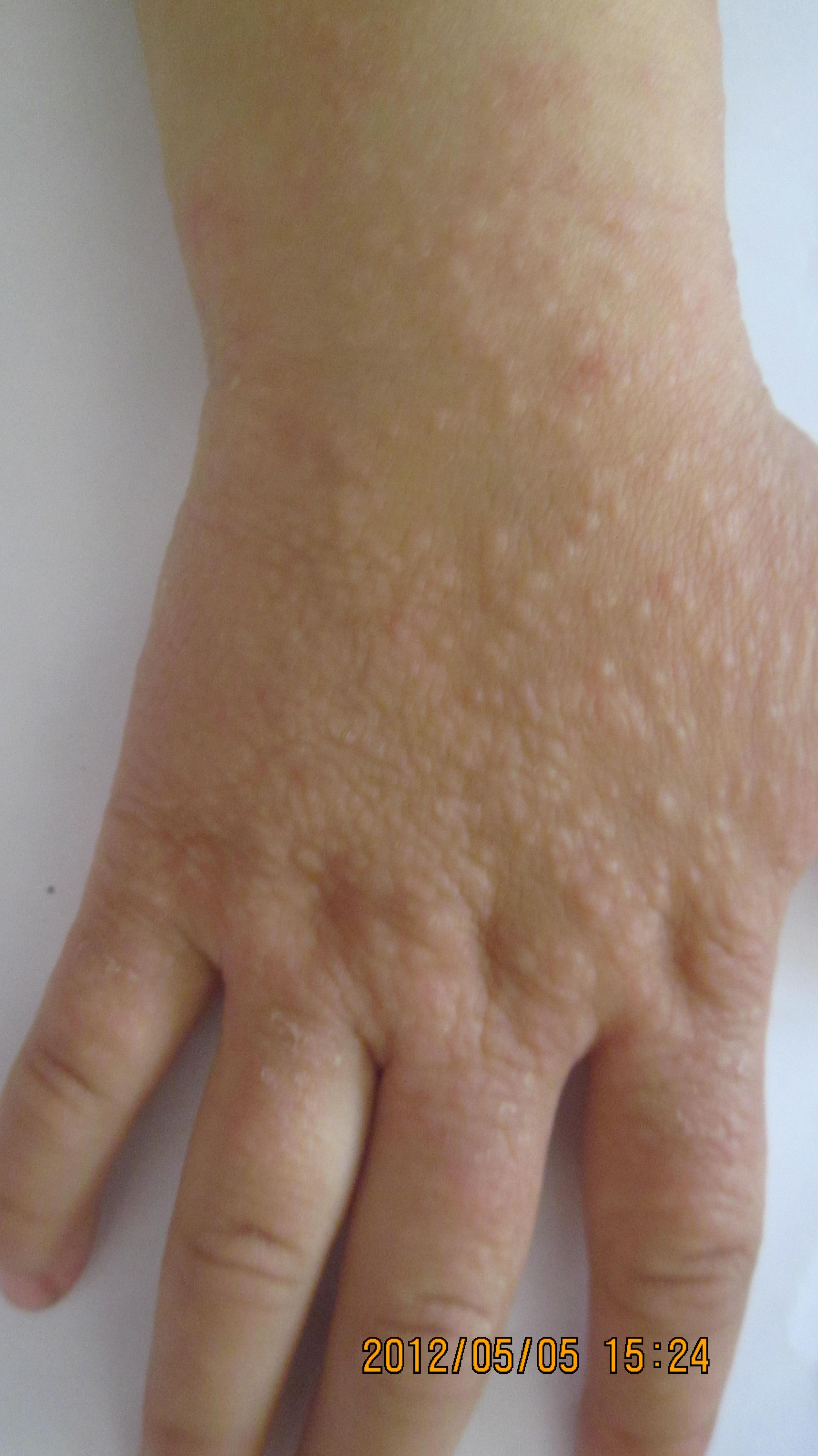 8是汗疱疹,遗传基因引起的手部皮肤病.