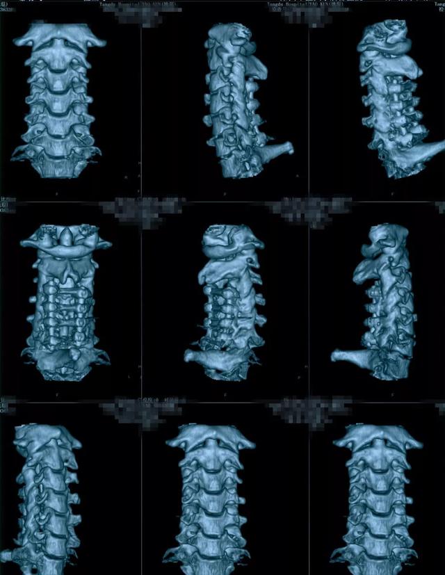 病例点评:颈椎管狭窄