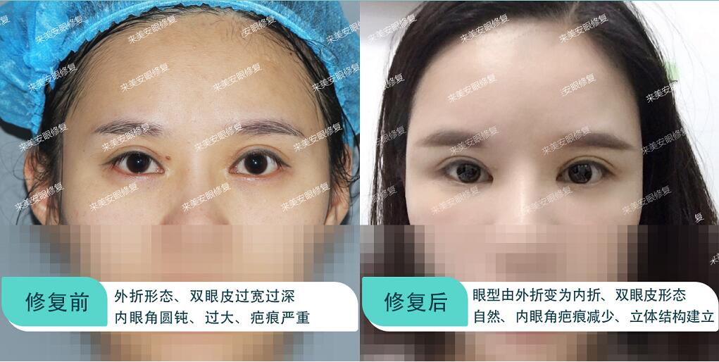 内眼角开坏了还能修复吗