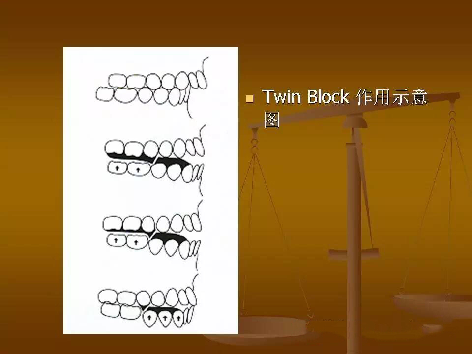 我为何选择放弃twinblock矫治器