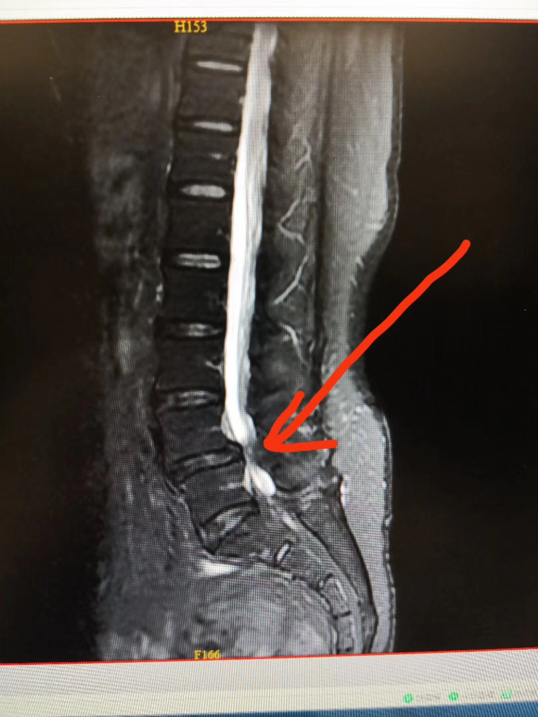 腰椎管狭窄腰椎滑脱的手术治疗案例