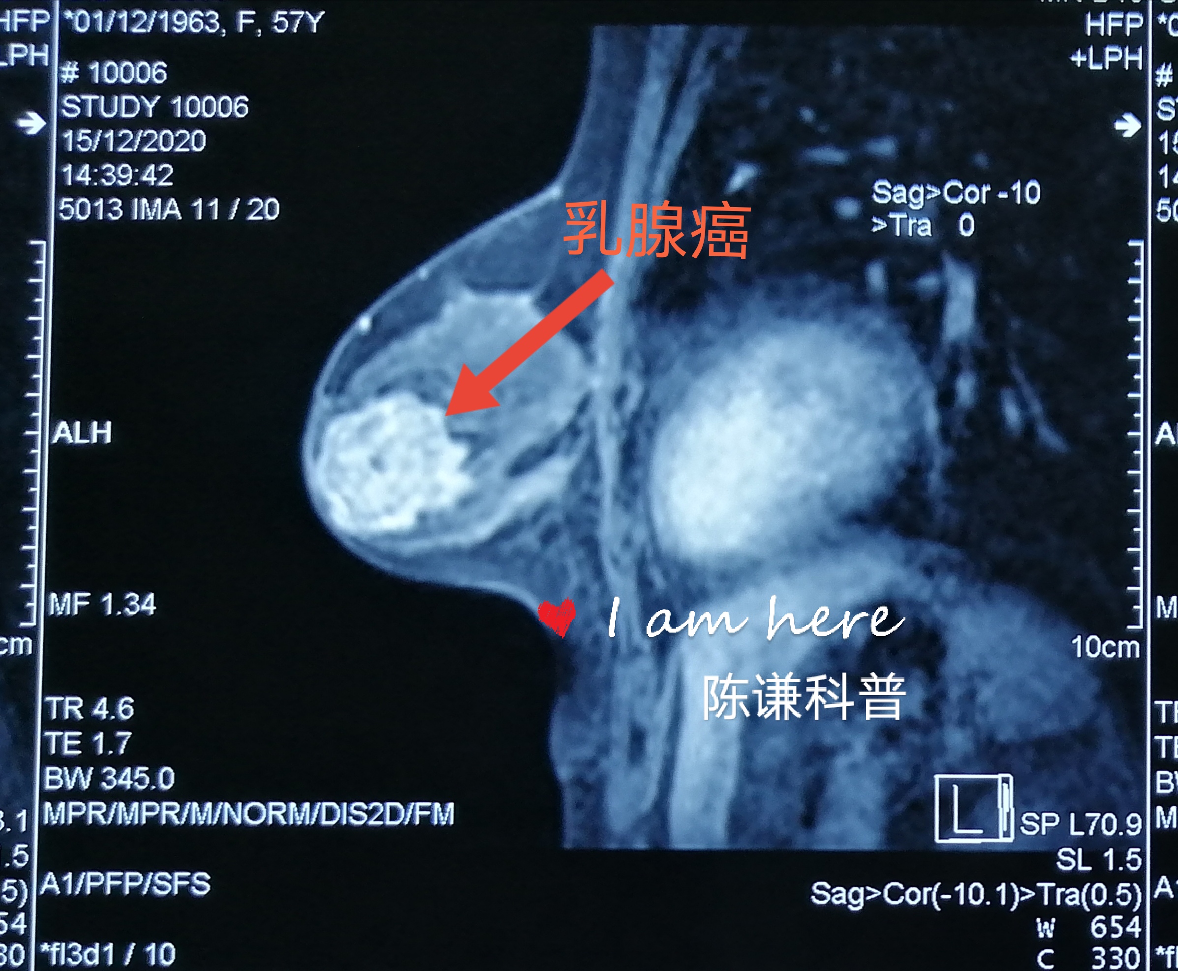 陈谦主任科普之乳腺癌病例