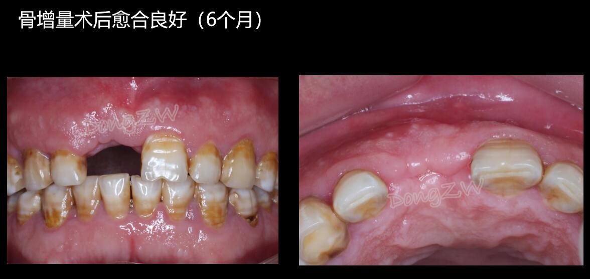 医生心得美学区复杂onlay植骨种植病例:男性患者52岁,门牙重度牙周炎