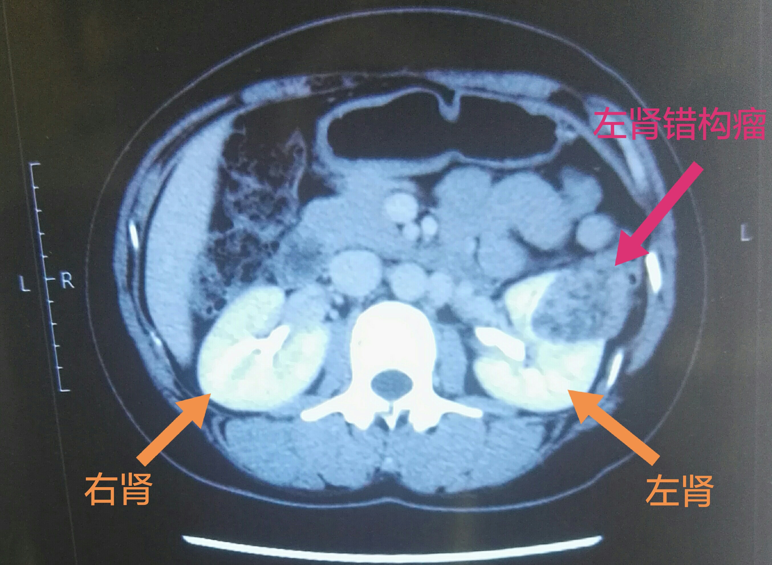 高尚病例：肾结石的双能量 CT 分析-医院汇-丁香园