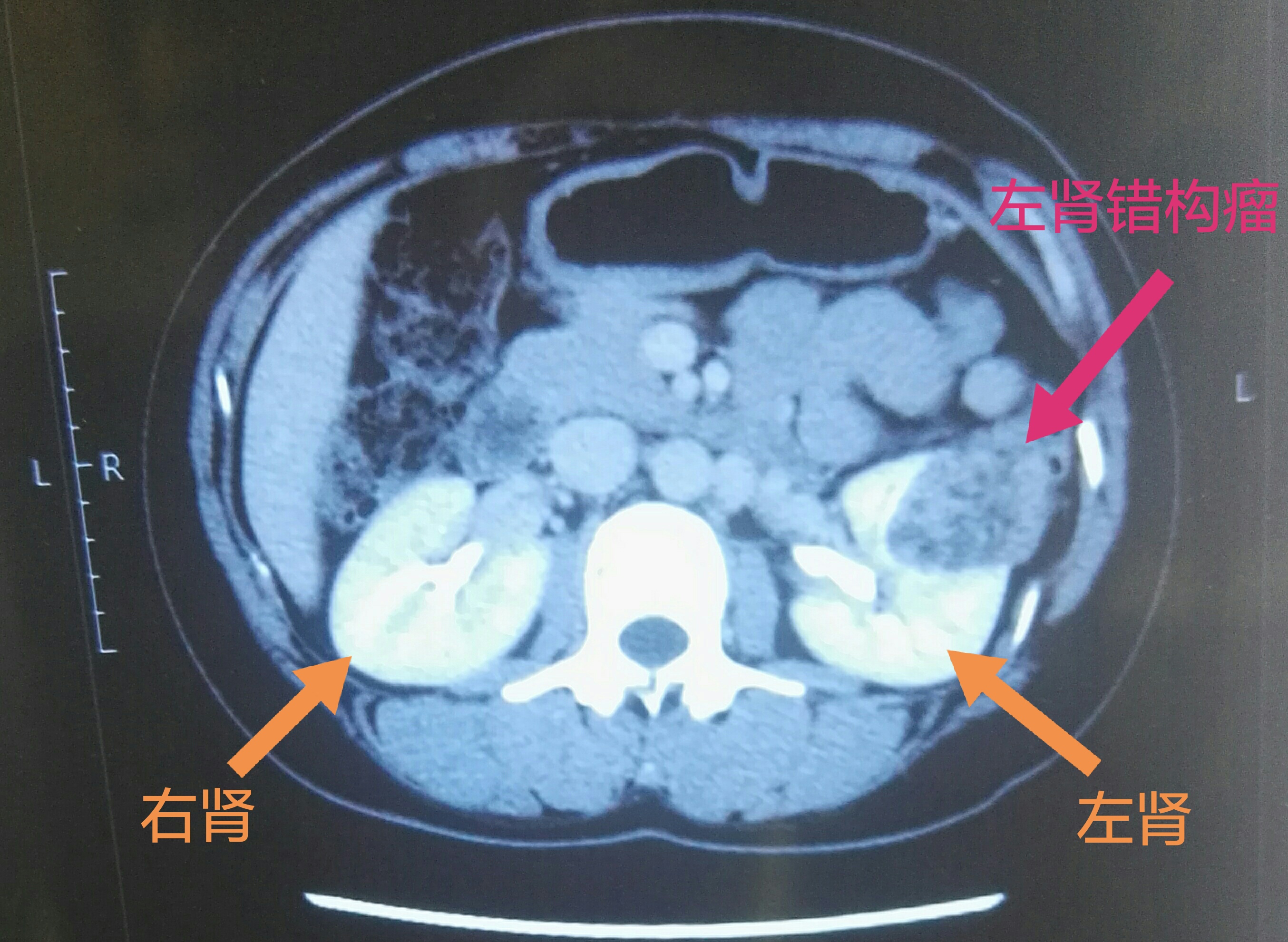 增强ct示左肾错构瘤(良性肿瘤)