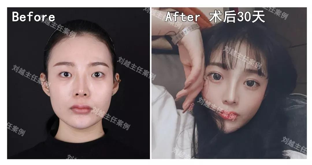 求美者术前一只单眼皮,一只内双,且内眦赘皮比较严重,这时不仅需要做