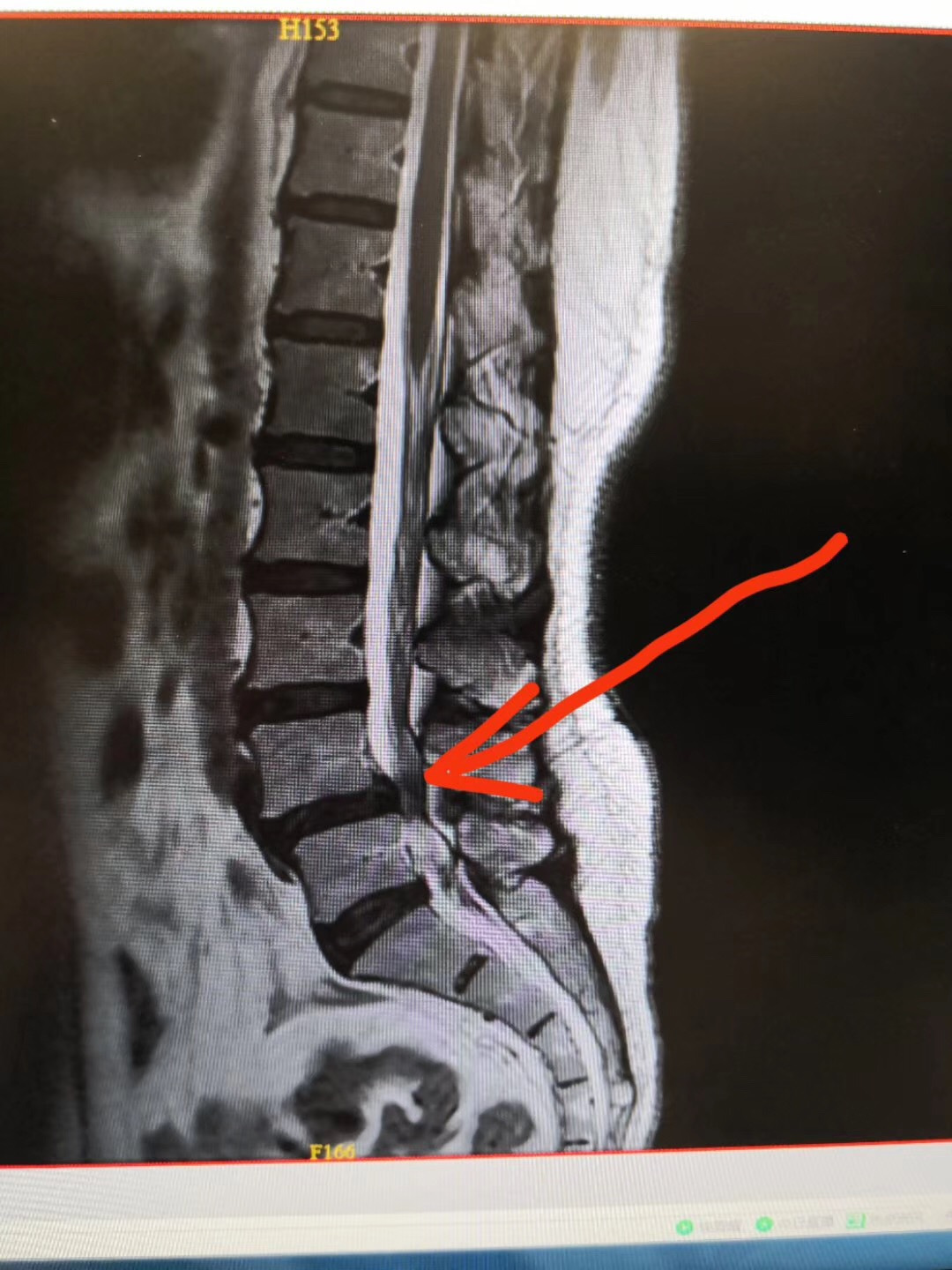 腰椎管狭窄腰椎滑脱的手术治疗案例