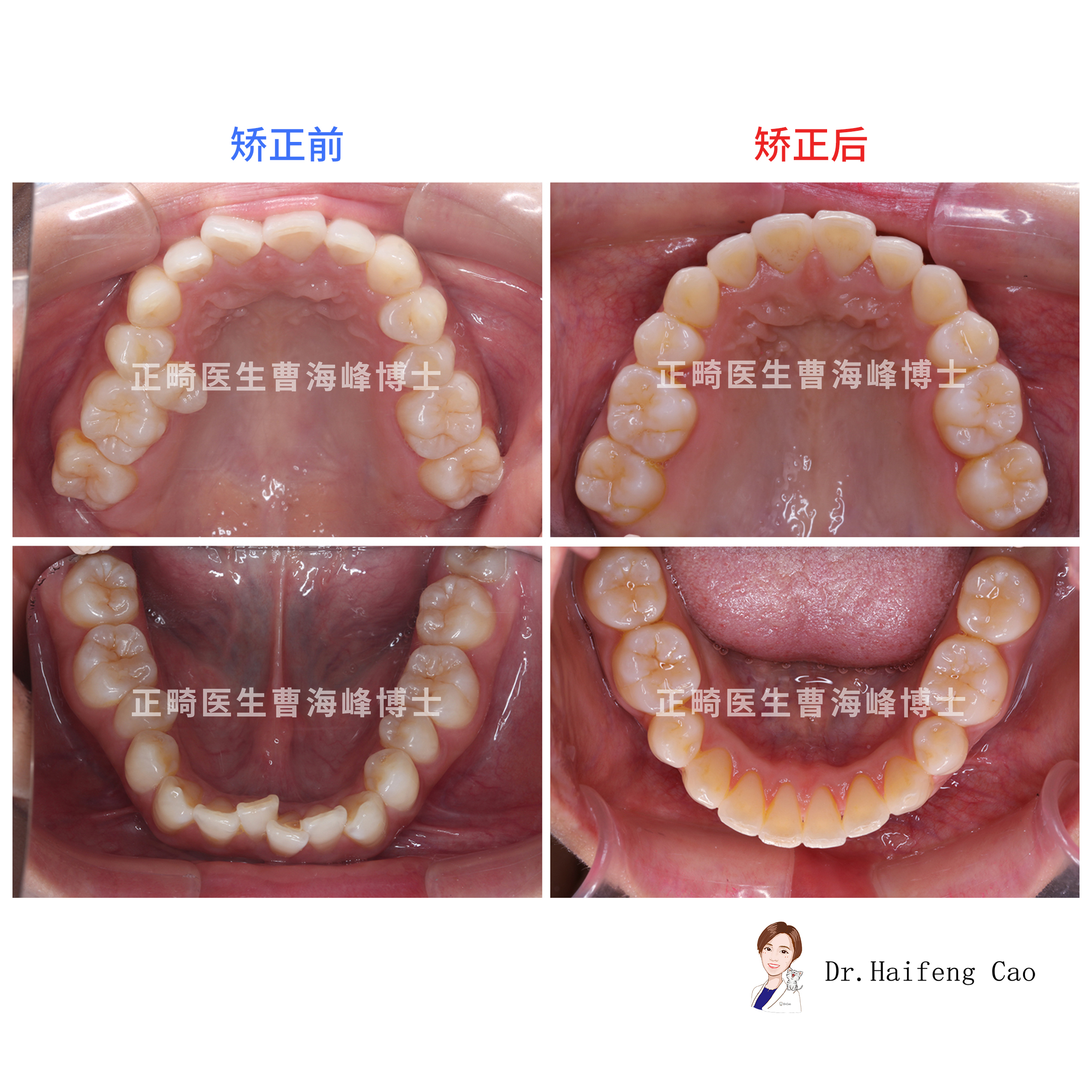 正畸治疗,拔除4颗5号牙,内收上前牙,改善唇突度,排齐牙齿.