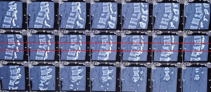 不慎高处坠落,导致腰2椎体爆裂性骨折,闭合性胸部损伤